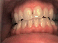 Teeth Whitening Before - Canton OH dentist