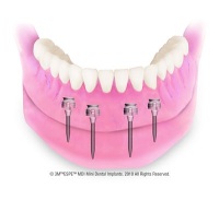Mini Dental  Implants Canton OH