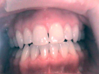 Teeth Whitening After