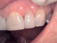 Porcelain Veneers